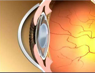 Cataract2.jpg