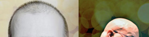 Balding12Tones.jpg