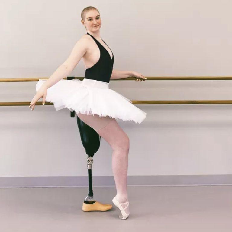 Dancer Has Leg Amputated, Then Carries On Dancing